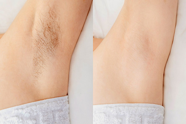 Women underarm hair removal. Concept before and after shaving sugar depilation laser.