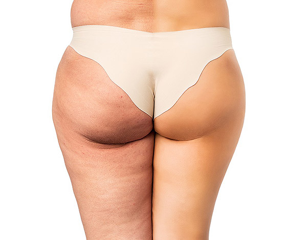 Cellulite problem concept, before and after